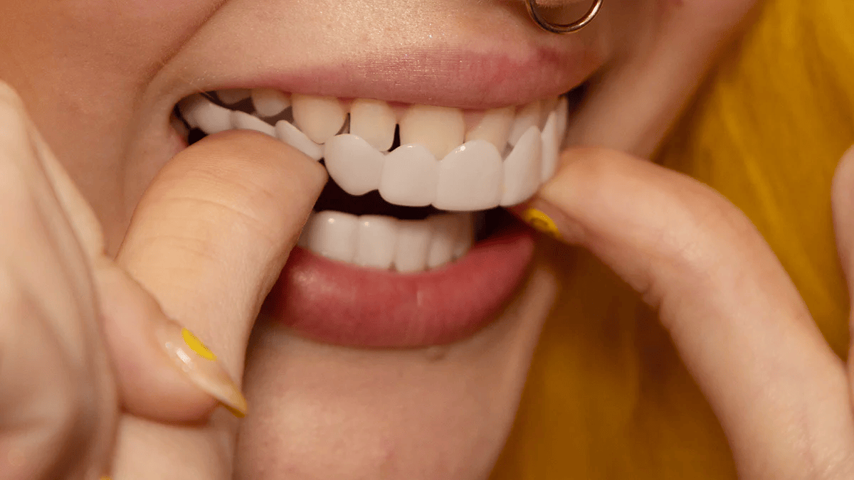 Snap on Smile Veneers Tandtransformatie Tanden