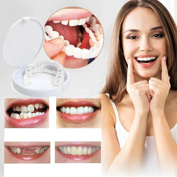 Snap on Smile Veneers Tandtransformatie Tanden