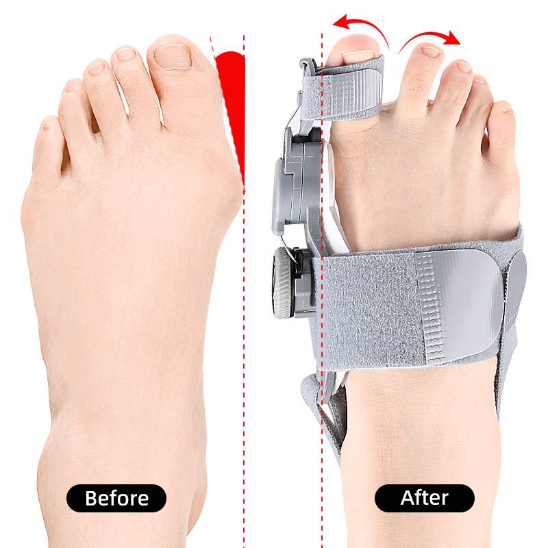 Bunion Corrector Tussenruimte voor Tenen