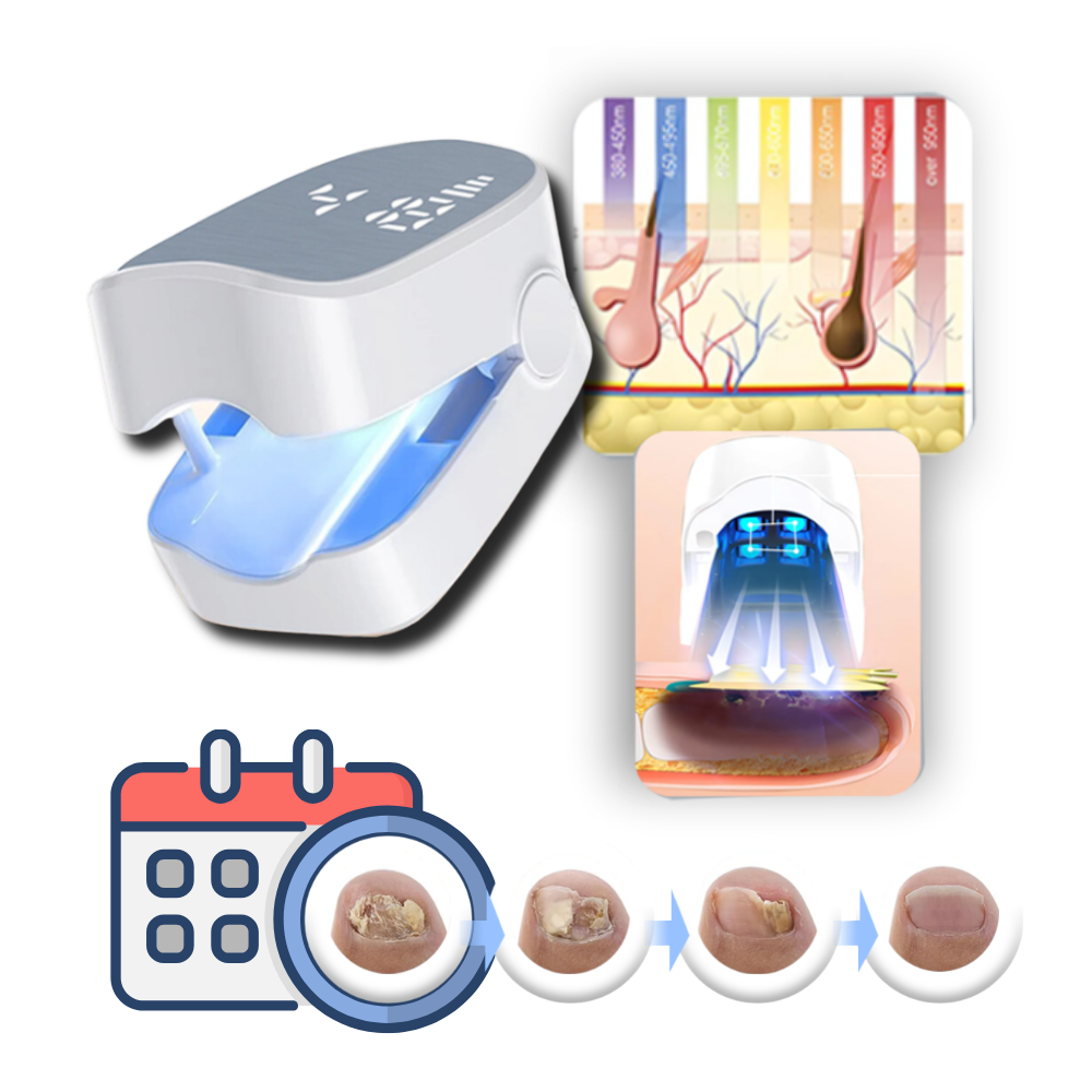 Lasertherapie Nagelschimmel Behandeling Pijnloos