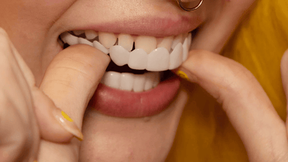 Snap on Smile Veneers Tandtransformatie Tanden