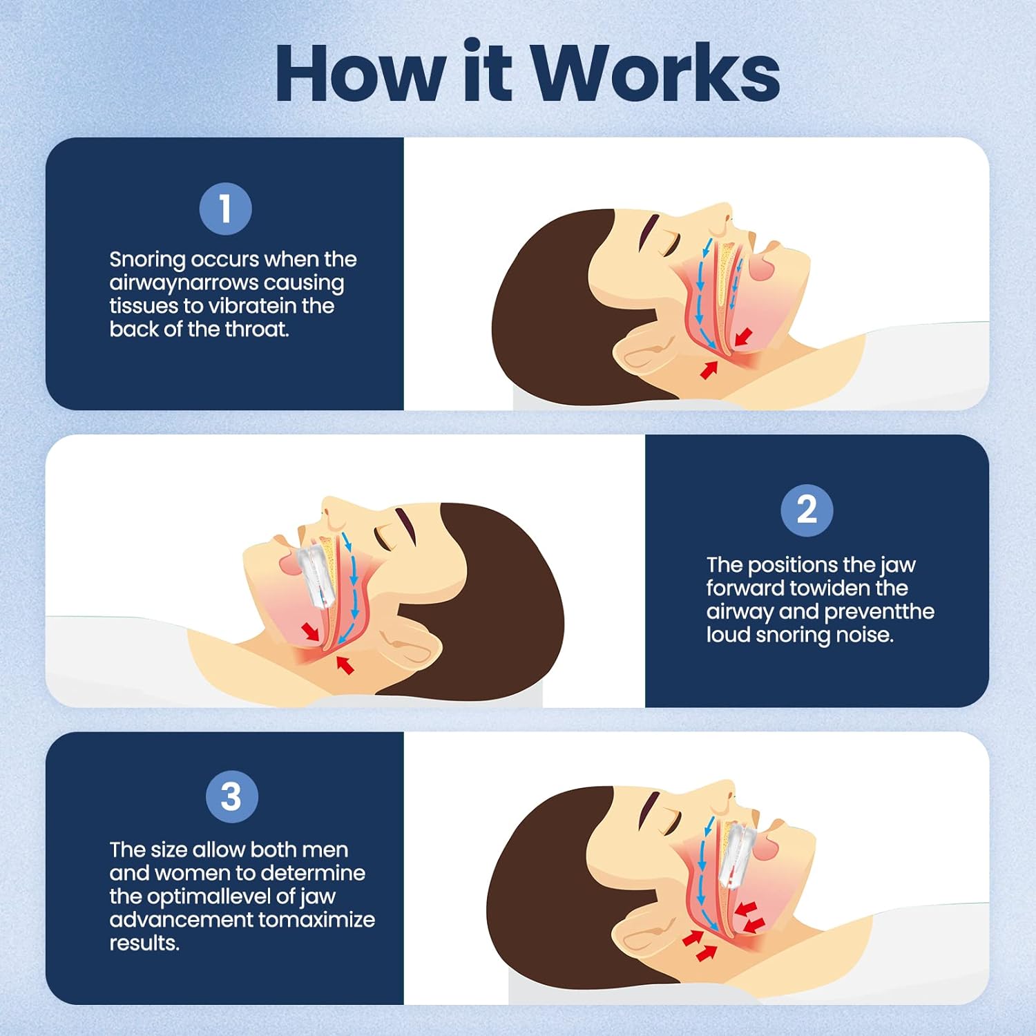 Anti-Snoringsmondstuk Slaapapneu Bescherming