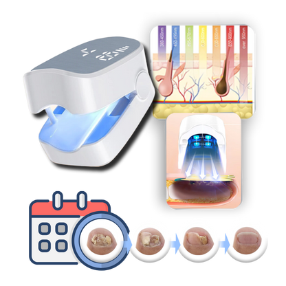 Lasertherapie Nagelschimmel Behandeling Pijnloos