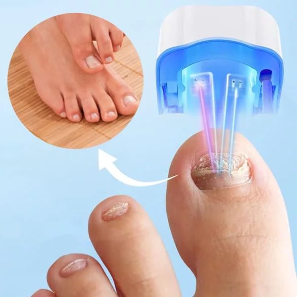 Nagelschimmel Reinigingslaser apparaat