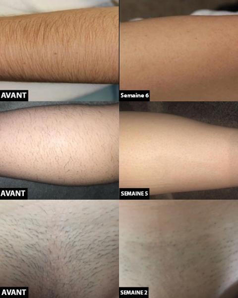 Permanent laser ontharing apparaat